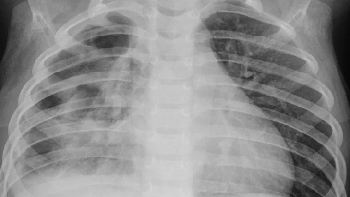 Keuhkokuumeen tunnistaminen röntgenkuvista